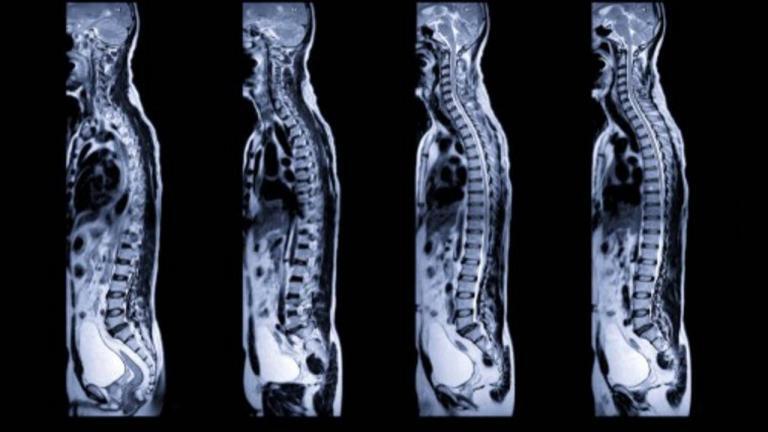 Thoracic Facet Loose Body