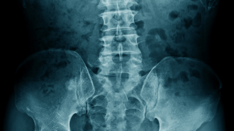 Why stay out of the Spinal Canal?