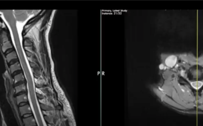 Why you should insist on oblique views of the Cervical Spine MRI