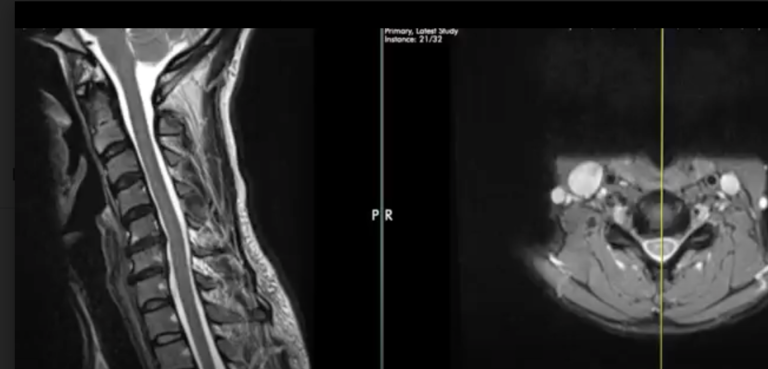 Why you should insist on oblique views of the Cervical Spine MRI